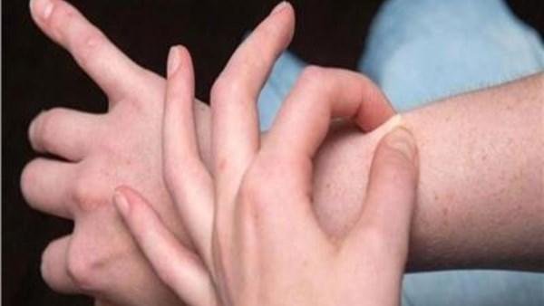 السنط الجلدي.. كل ما تريد معرفته عن أسبابه وطرق انتقاله وعلاجه
