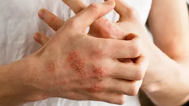 كيفية علاج الإكزيما في اليد؟.. 5 طرق لتخفيف الأعراض