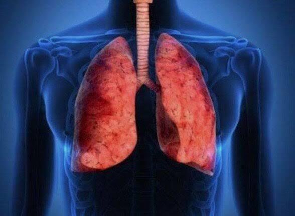 بعد وفاة فنية مختبر روسية وتعليق ترامب.. ماذا نعرف عن الطاعون الرئوي؟