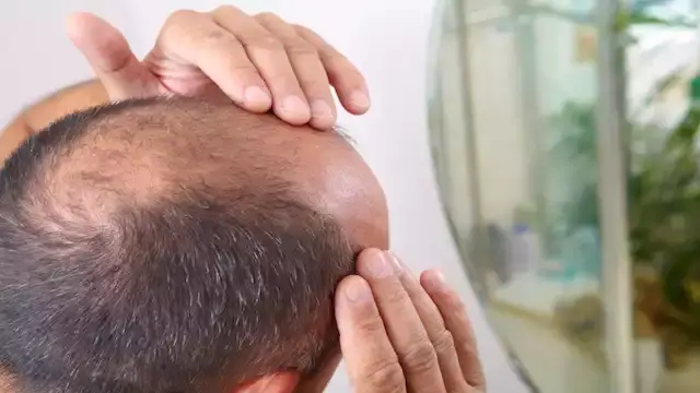 بعد تحذير هيئة الدواء.. مخاطر مستحضرات علاج الصلع المغشوشة