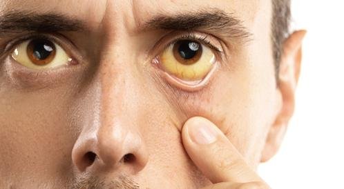 هل كل حالة صفراء تعنى الإصابة بالتهاب الكبد الفيروس الوبائى؟