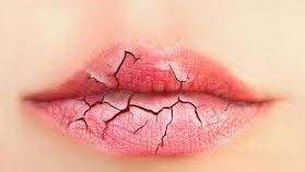 تشقق الشفاه في الخريف.. 7 أخطاء تمنع علاج الجفاف