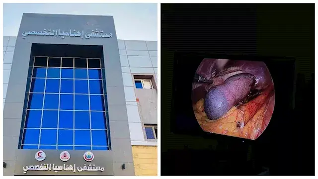 لأول مرة.. مستشفى إهناسيا التخصصي يجري استئصال الطحال بالمنظار لمريضة 59 عامًا