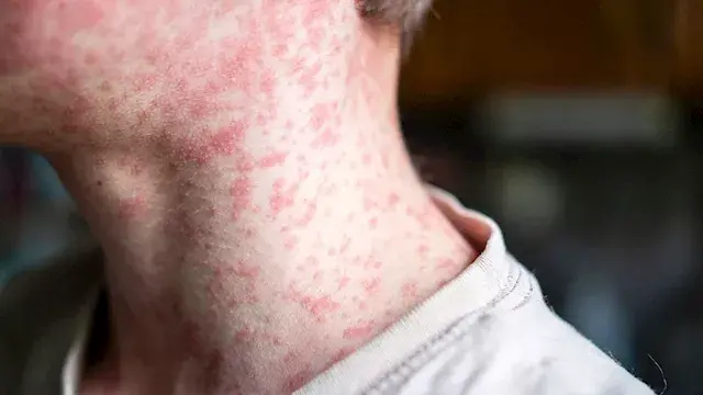 بعد انطلاق حملة التطعيمات.. 5 أعراض شائعة تكشف الإصابة بالحصبة