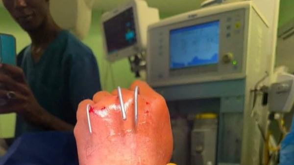 بعد 6 ساعات .. فريق جراحة التجميل بمستشفيات جامعة أسوان ينجح في إعادة «يد مبتورة»