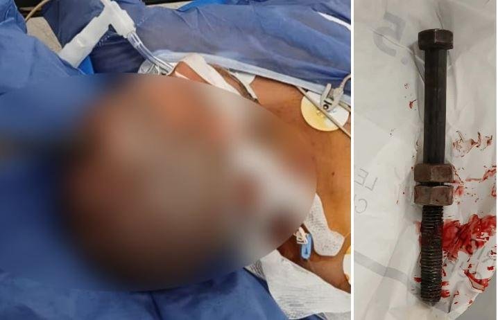 جراحة استغرقت 4 ساعات.. أطباء قصر العيني يستخرجون مسمارا من جمجمة مريض