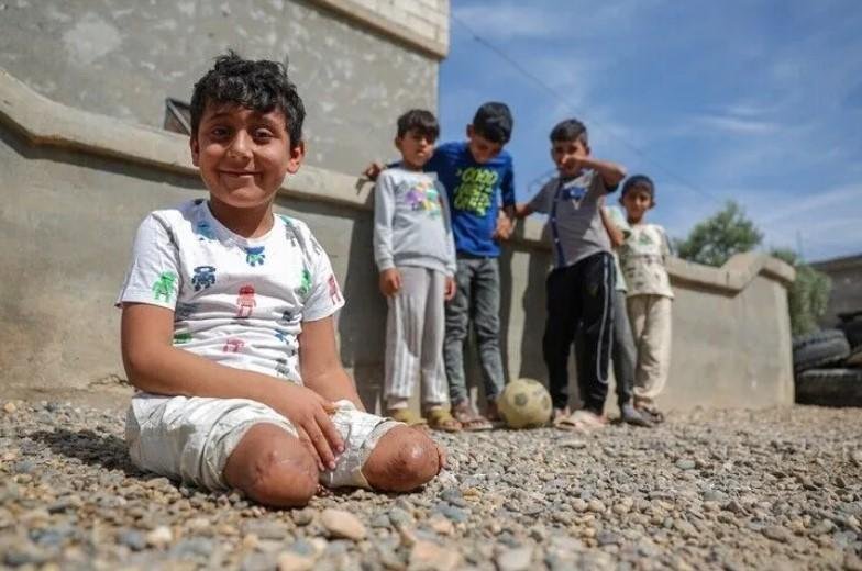 فقد ساقيه وبقي شغفه.. طفل سوري يلعب كرة القدم بيديه بعد انفجار لغم