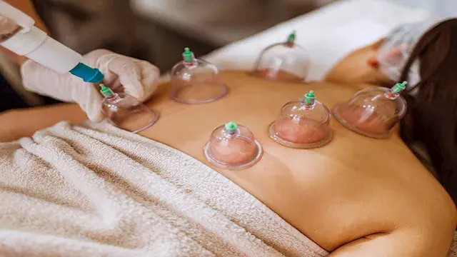 5 فوائد محتملة للحجامة.. هل تس...