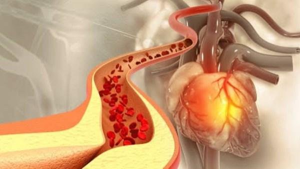 5 أنماط .. كيف تتجنب الإصابة بارتفاع الكوليسترول ومضاعفاته؟